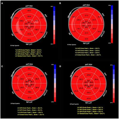 Evaluation of left ventricular myocardial stratified strain in patients with Kawasaki disease using two-dimensional speckle tracking imaging